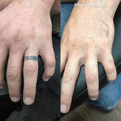 removery tattoo removal & fading|tattoo removal before and after pictures.